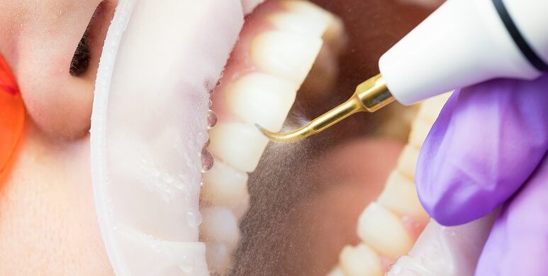 dentista aplica una limpieza dental ultrasonica