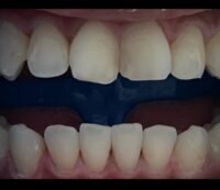 despues-dientes-tratamiento-laser-blanqueamiento-2